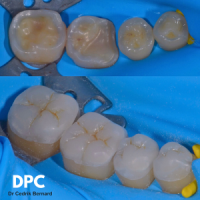 Prise en charge érosion et usure DPC 2026